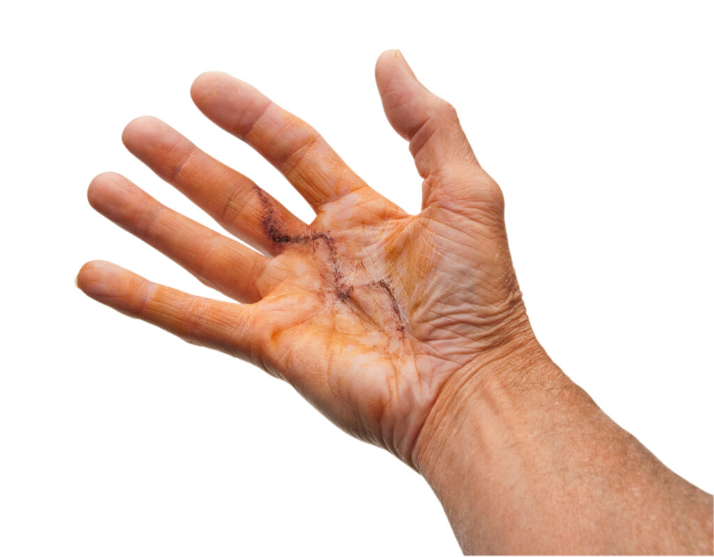 Hand mit Narbe nach Operation